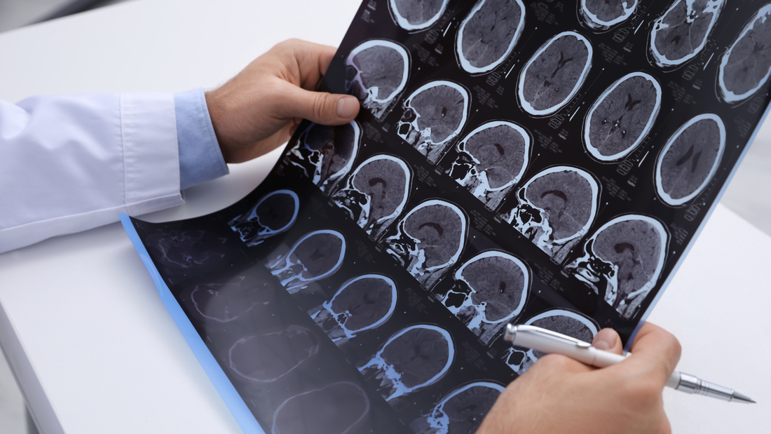 Esclerosis múltiple: factores de riesgo