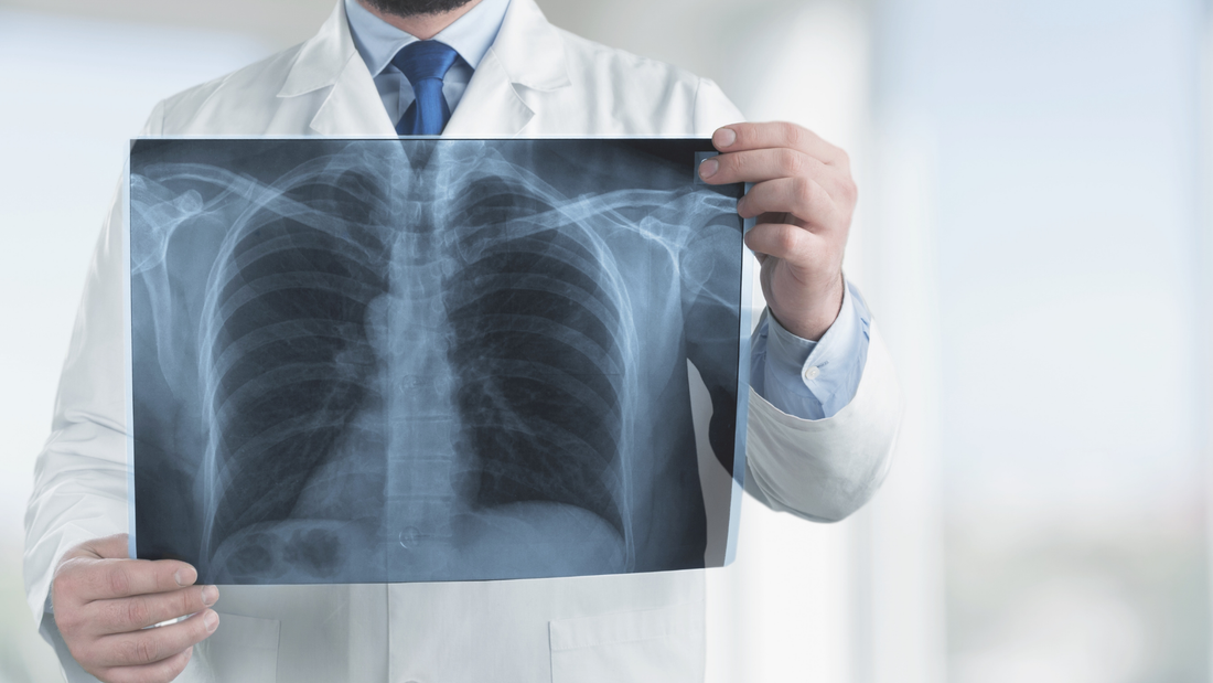 Fibrosis quística: características y herencia