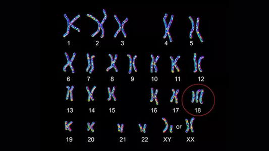 Qué es el Síndrome de Edwards: características