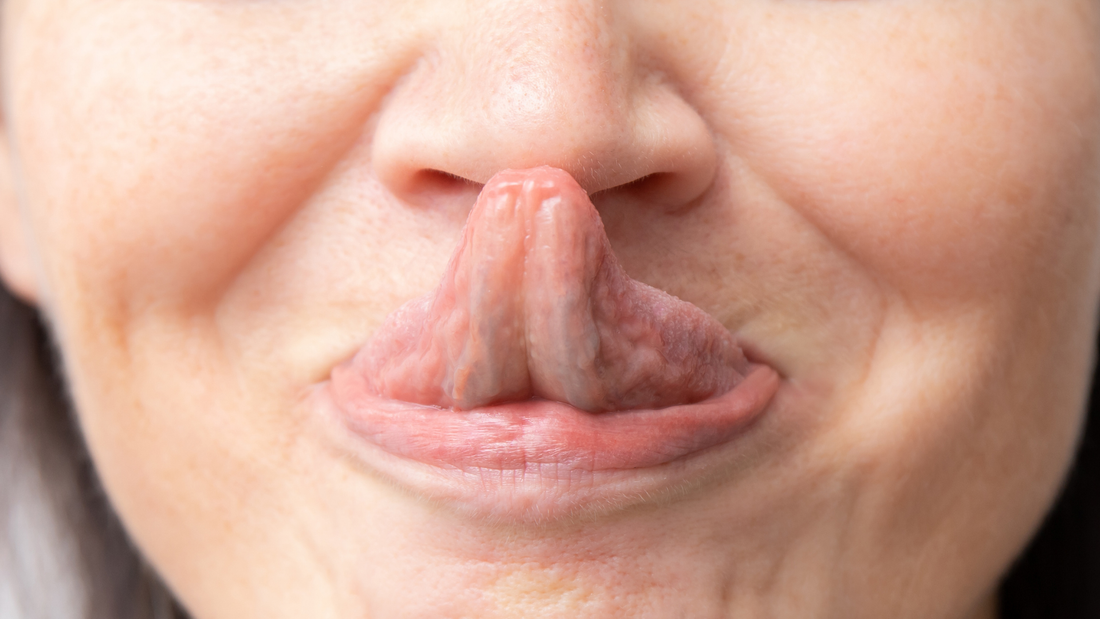 Enfermedades genéticas: Síndrome de Ehlers Danlos