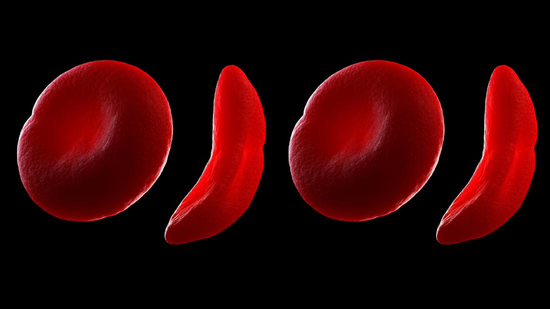Enfermedades genéticas: Anemia de Células Falciformes